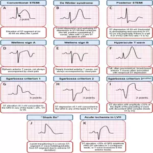 ECG STEMI Equivalents